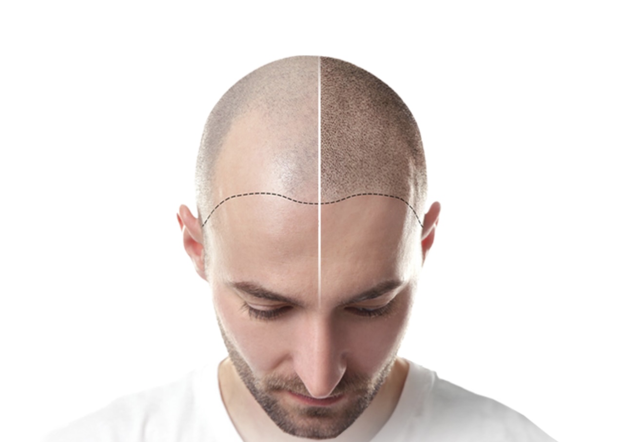 KEEP hair transplant natural results